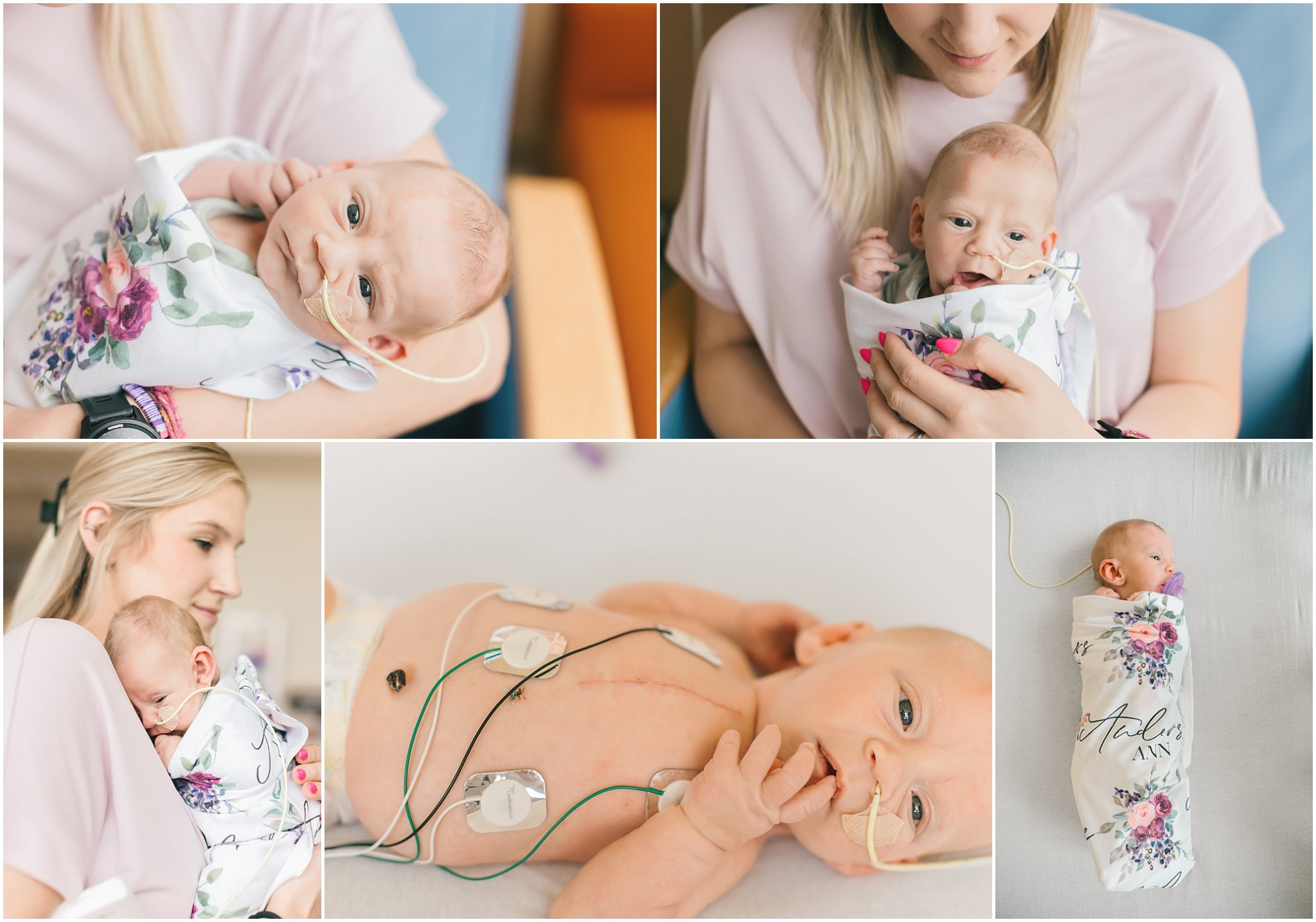 Turners syndrome baby
